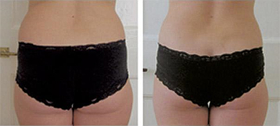 Perfectly You > Strawberry Laser Lipo > Stomach Before & After